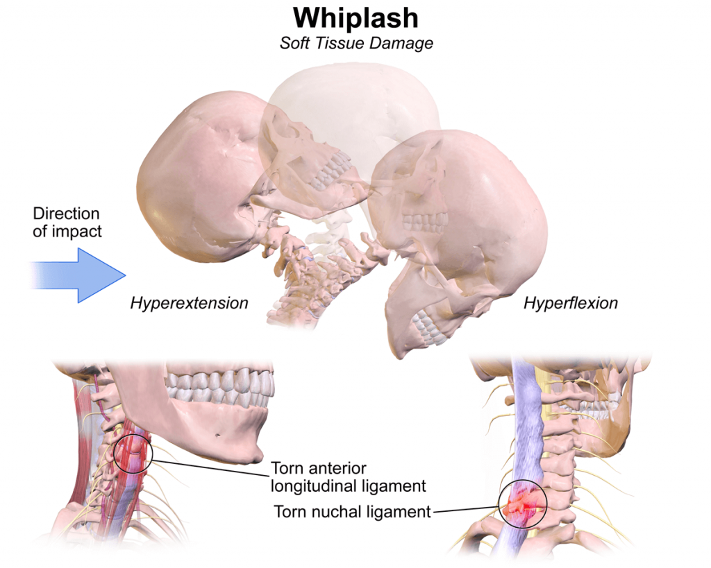 What Do I Do if I Think I Have Whiplash?